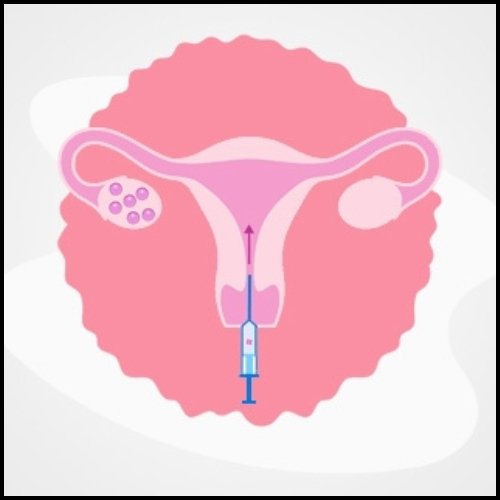 Frozen Embryo Transfer - Healix Hospitals