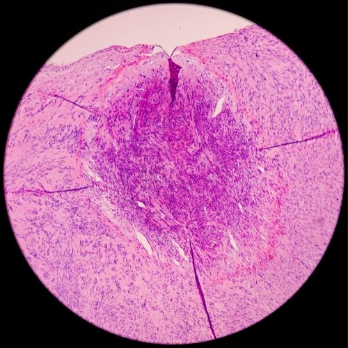 Head Cyst Prevention - Healix Hospitals